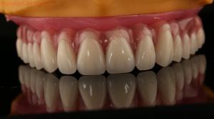 Quality Acrylic Partial Implant Over Denture Titianium Bar Full Denture Teeth Set Up Screw Retained wholesale