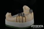 Steel Locator Dental Attachments , Precision Partial Denture Attachments