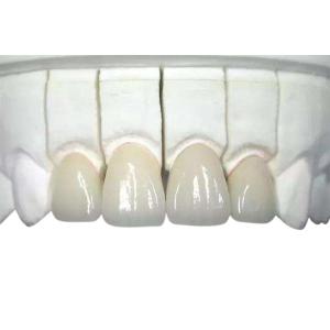 Quality 3D Printed Zirconia Dental Crown Wear Resistant Highly Biocompatible wholesale