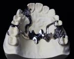 Cr Co Partial Denture Metal Framework