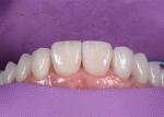 0.3MM Whitening Ceramic Dental Crown To Replace Unhealthy Teeth