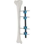 Condylar External Fixation Device