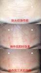 Beauty Equipment Hot Sale Fractional Rf Microneedle Skin Solution Beauty Tighten