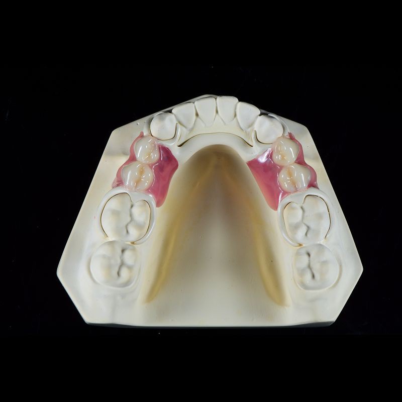 OEM Peek Cast Metal Framework Partial Denture User Friendly