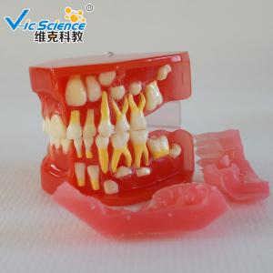 Quality Advance PVC Plastic Child Caries Teeth Model Dental Life Size Eco - Friendly wholesale