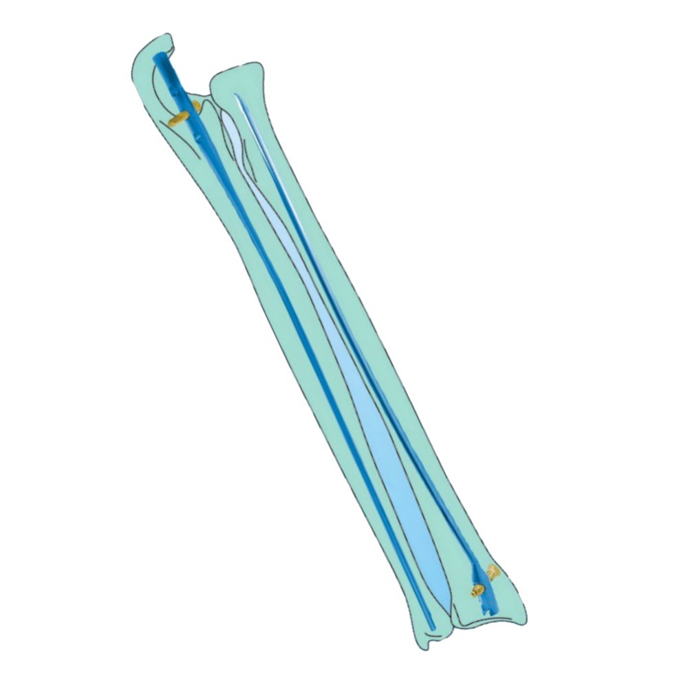 Titanium Intramedullary Nail System Orthopedic Proximal Femoral