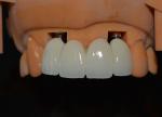The Strength Behind Our Success Our Dental Implant Crown Technicians