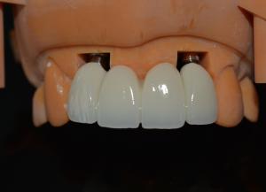 Quality Precise CAD/CAM Design Zirconia Dental Crown for Fitment wholesale