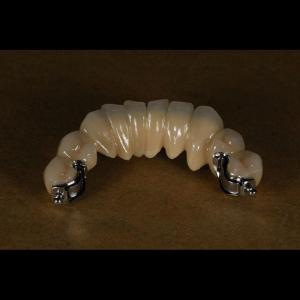 Quality Aesthetic Partial Denture Precision Attachments Medical Grade OEM wholesale
