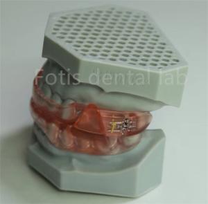 Quality Affordable Dental Lab Hyrax Expander Orthodontic Retainer Easy To Clean And Maintain wholesale