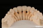 High Translucency Layered Zirconia Crowns Bridges Dental Restorations lifelike