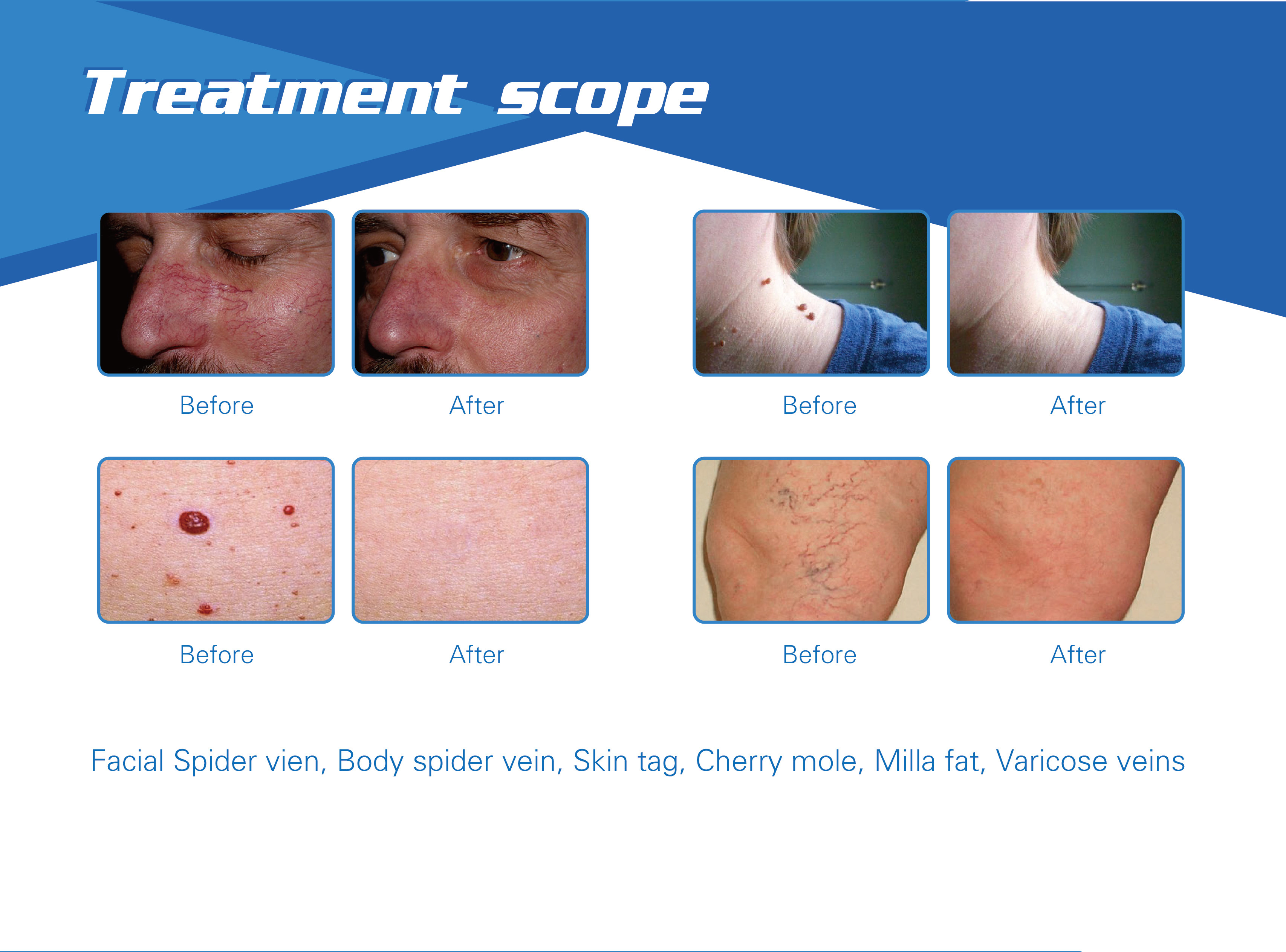 laser varicose vein removal treatment 980nm laser vascular removal machine portable