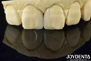 Quality Customizable Smooth Micro Thin Veneers Long Lasting Natural Looking Veneers wholesale