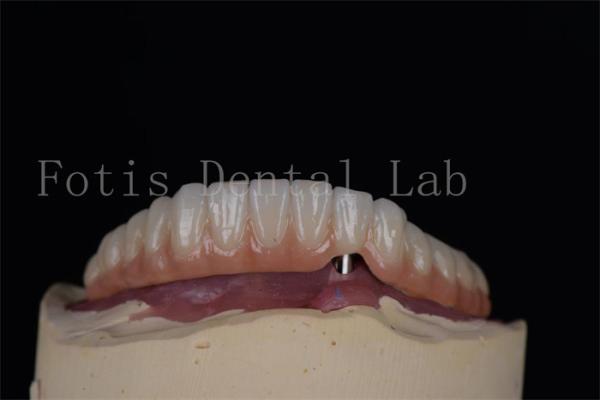 Natural looking Titanium or Zirconia Dental Implants Minimally Invasive