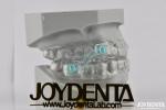 Custom Fitting Sleeping Aid Mouthpieces Dental Appliance To Stop Snoring