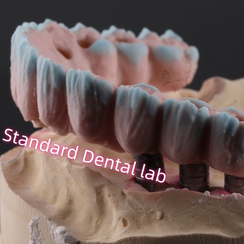 Zirconia Implant Bridge Screw Retained With Pink Gum Porcelain