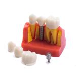 Class III Instrument Classification Dental Study Model for Dental Practice and