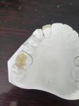 Durable FDA All-Ceramic Dental Crown Veneer Inlay Onlay Similar