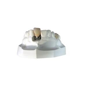 Quality Custom Dental Implant Locators High Stability Bar Attachment Denture wholesale