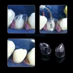 Transparent Temporary Preformed Pre-Crown Matrices Matrix for Dental Tooth