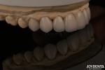 Feldspathic Natural Looking Cosmetic Veneers Precise Fit Highly Translucent