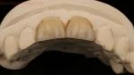 Full Contour Zirconia Crown and High Aesthetic Natural Dental Bridge 5 Year