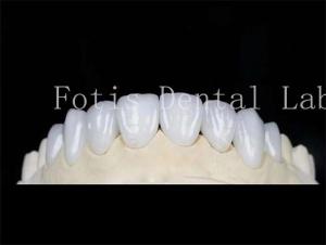 Quality Natural Color Dental Laminate Veneers Fake Teeth Veneers With Bonding Cement wholesale