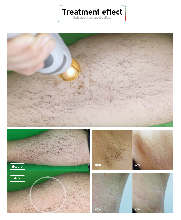 755nm and 1064nm ND Yag Can Gentle Laser Hair Removal Machine with 3-200ms Pulse Width