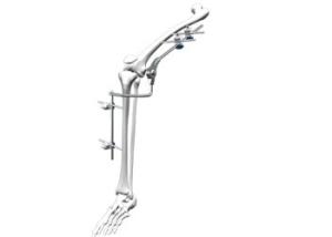 Quality Universal Orthopedic External Fixator Sliver / Blue Color Fit Knee Joint wholesale