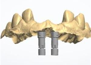 Quality 3D model Zirconia crown wholesale