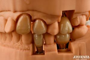 Quality Customizable Implant Crown and Bridge Achieve a Natural Look with Long-lasting Results wholesale