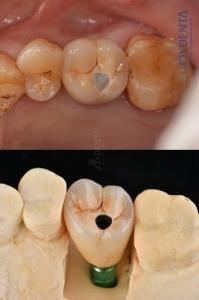 Quality Titanium Full Arch Dental Implants Prosthetic Platform 4.1mm For Exceptional Durability wholesale