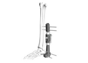 Quality Infected Nonunion Orthopedic External Fixation Device With Hex Wrench wholesale