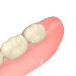 Natural Looking Denture Bases Biocompatible Resin Optimal Patient Comfort