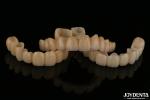 Natural Looking Porcelain Layered Zirconia Bridges Wear Resistance High