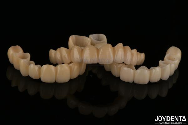Natural Looking Porcelain Layered Zirconia Bridges Wear Resistance High