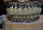 Corrosion Resistant Co Cr Implant Supported Metal Crown Biological Material