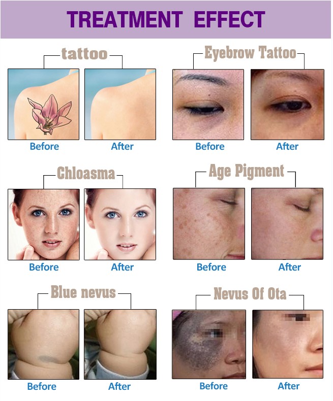 Long Pulse Nd YAG Laser Hair Removal Machine Portable For Commercial