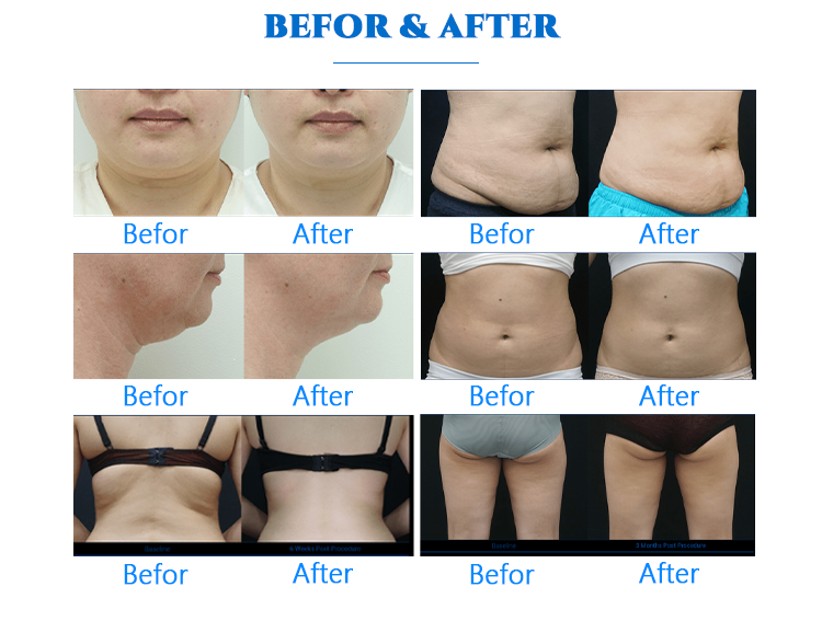 10kpa 360 Degree Cryolipolysis Fat Freezing Machine Professional