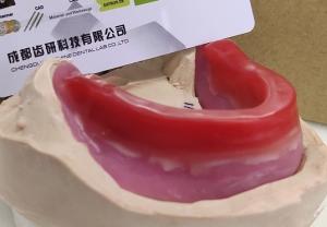 Biteblocks For Jaw Relation Before Complete Denture