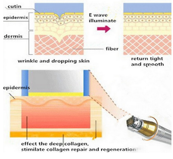 Semiconductor RF Skin Tightening Machine for Skin Lifting, Skin Tightening