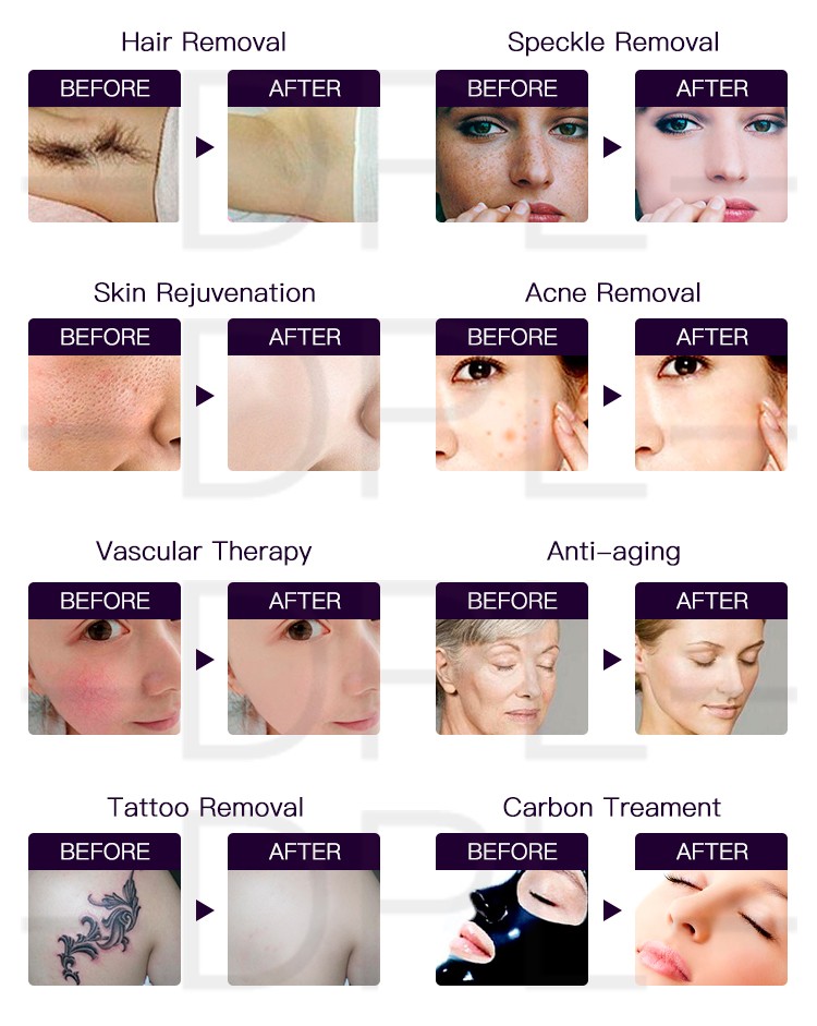 DPL 3 in 1 Skin Rejuvenation Elight IPL OPT Laser Nd Yag Laser Multi-functional ipl laser hair removal and tattoo removal