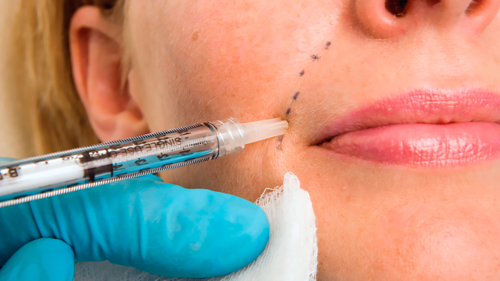 Hyaluronic Acid Wrinkle Injection Fillers HA Face Breast Buttock Filler Injection