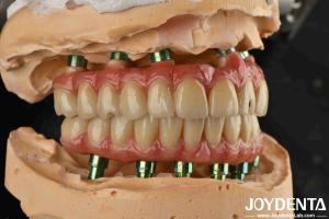 Quality Hybrid Technology Titanium Malong Dental Bridge Adjustable For Aesthetic Results wholesale