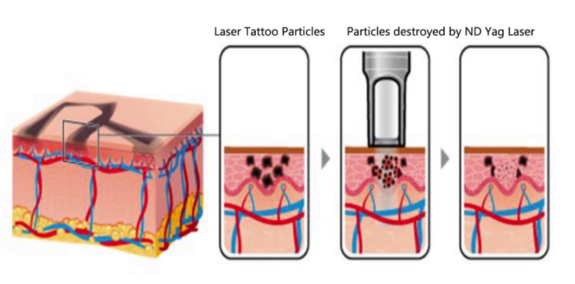 1064nm 532nm Picosecond Laser Machine 755nm Tattoo Removal