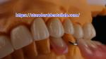 Layered Dental Zirconia Crown And Bridge Translucency 3D PRO Zirconia Porcelain