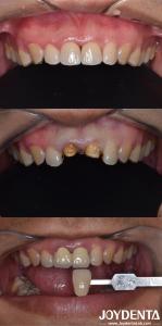 Quality Biologically Oriented Preparation Technique Dental vertical Preparation Minimally Invasive wholesale