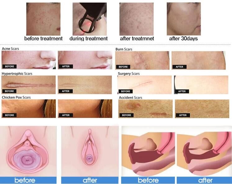 Scar Removal Fractional CO2 Laser Beauty Equipment With 10.4 Inch LCD Touch Screen