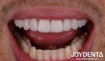 Perfect Fit Porcelain Teeth Veneers Natural Transparency Dental Laminate Veneers