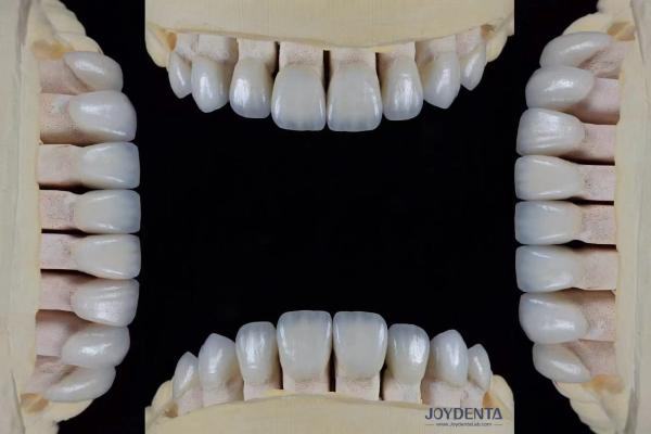 Ultra Thin Feldspathic Veneer 0.3-0.5mm Thickness High Stain Resistance Precise